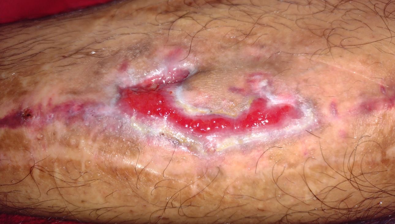 Imagen clínica de herida (1)